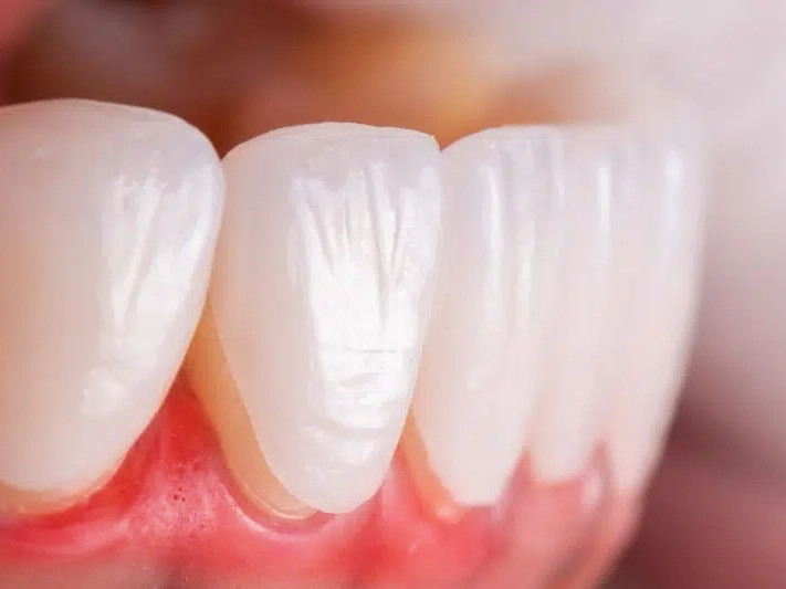 Răng sứ bị hở chân răng lâu ngày có thể hình thành viêm nướu, viêm nha chu